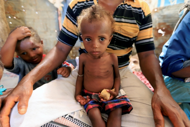 Dünyanın göz yumduğu utanç: Küresel açlık krizi